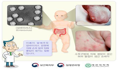 수족구병 <사진=질병관리청 제공>